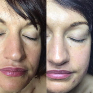 hollywood facelift in portsmouth maine